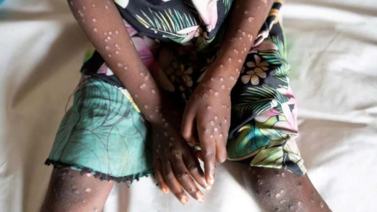What Is Mpox and How is It Spread?